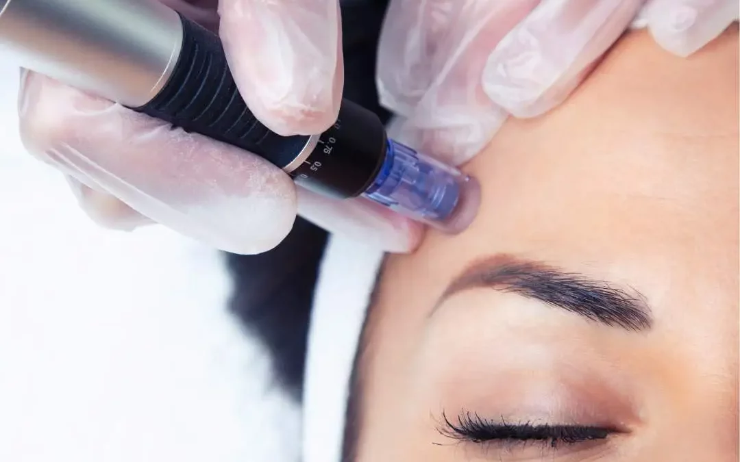 Dermapen facial